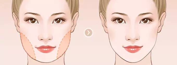 做下頜角整形手術效果好嗎？下頜角整形手術要多少錢？