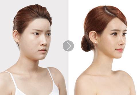 自體脂肪填充眉弓安全嗎？自體脂肪填充是永久的嗎？