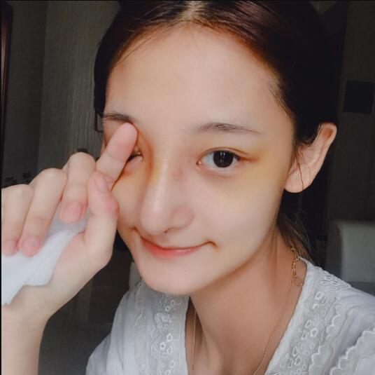 成都蜀尚蓉雅美容整形醫(yī)院做鼻綜合術(shù)后的最終恢復(fù)情況 成都蜀尚蓉雅美容整形醫(yī)院做鼻綜合術(shù)后的最終恢復(fù)情況