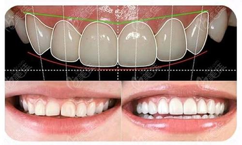池州博雅口腔全瓷牙有何優(yōu)點？全瓷牙與烤瓷牙有何區(qū)別？