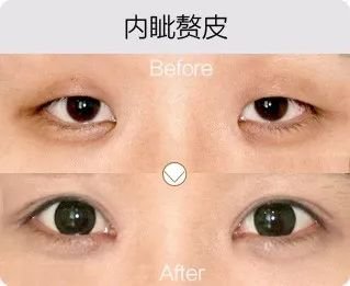 哈爾濱成美整形內(nèi)眥贅皮矯正怎么樣有哪幾種手術(shù)方法？