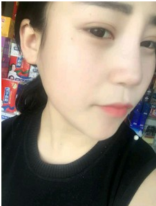 上海時(shí)光整形外科醫(yī)院做耳軟骨隆鼻術(shù)后自然的鼻子