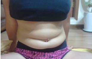 東莞華美醫(yī)療美容醫(yī)院做腰腹吸脂術前