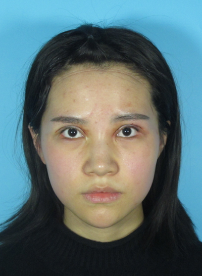 成都美立方（原華博）醫(yī)療美容醫(yī)院張娟眼部修復案例效果分享